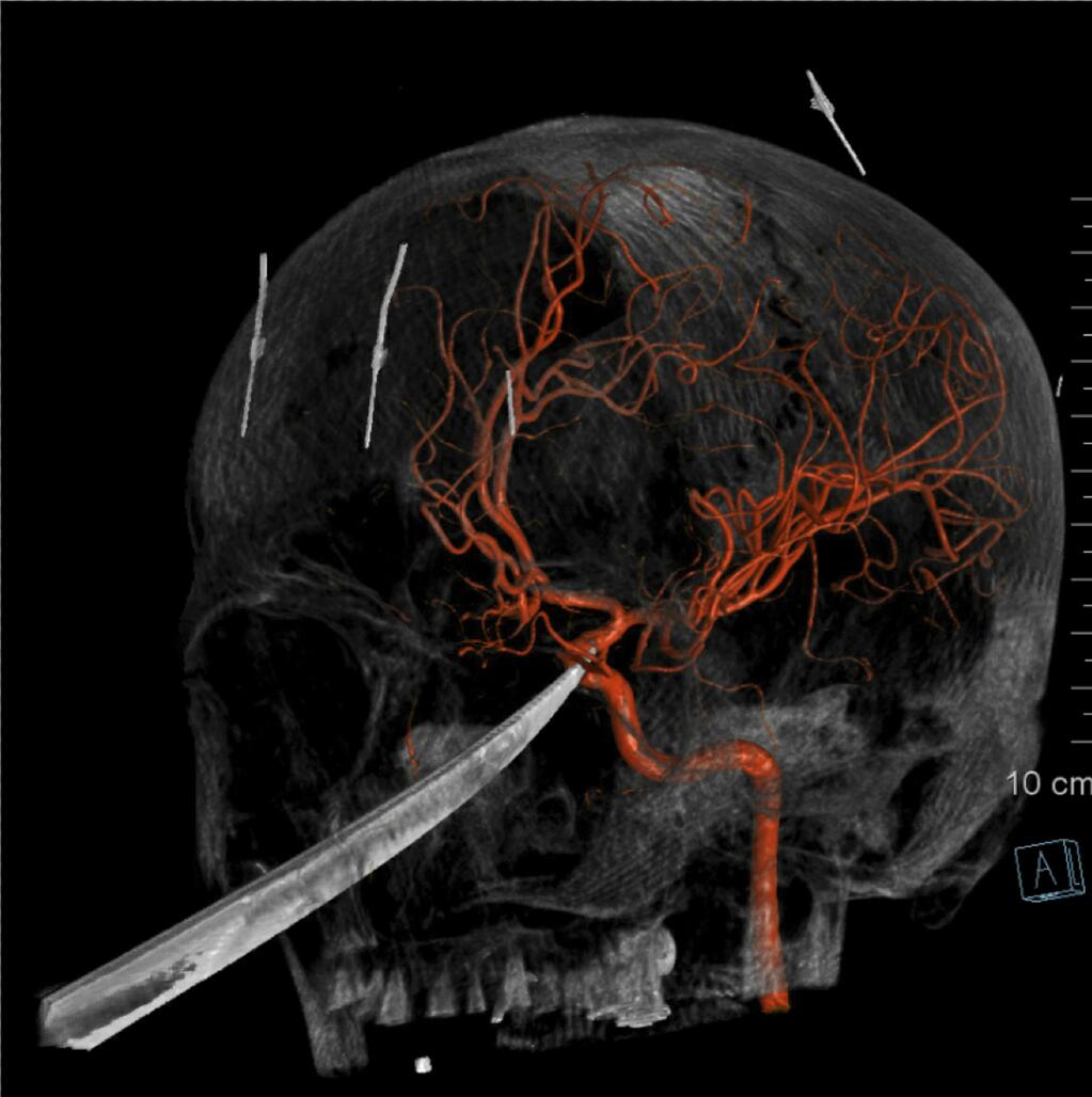 This 3D computer graphic model made from X-Ray imagery by The University of Kansas Health System shows how a tip of the knife stopped right on and was pressed against the carotid artery as the X-Ray image shows the skull of Eli Gregg. The 15-year-old Kansas boy is recovering days after doctors removed a 10' knife that impaled his face when he fell while playing. Gregg's harrowing experience began late Thursday, June 13, 2019, when he was playing outside his home in Redfield, about 11 miles from Fort Scott in southeast Kansas. The knife was embedded into his skull, extending to the underside of the brain. The tip of it had indented the carotid artery, the major artery which supplies blood to the brain. Surgeons at The University of Kansas Health System removed it Friday morning. Eli is expected to be able to go home Monday and should recover fully. (The University of Kansas Health System via AP)