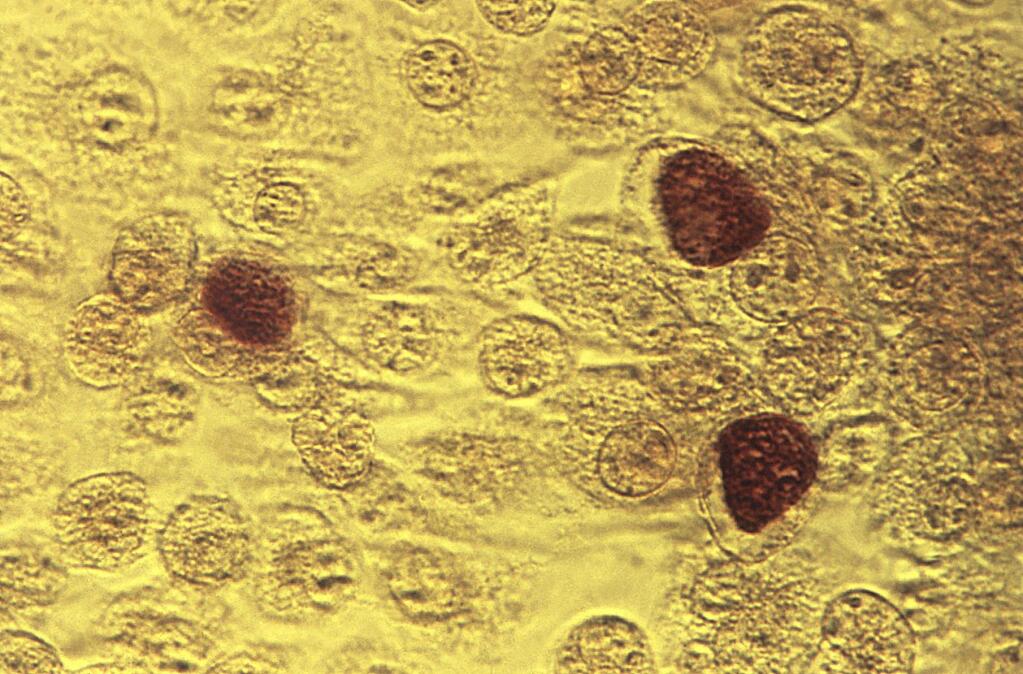 This 1975 microscope image made available by the the Centers for Disease Control and Prevention shows Chlamydia trachomatis bacteria magnified 200X. A report by the CDC released on Wednesday, Oct. 19, 2016 says infections from three sexually spread diseases have hit another record high. Chlamydia was the most common. More than 1.5 million cases were reported in the U.S. last year, up 6 percent from the year before. (Dr. E. Arum, Dr. N. Jacobs/CDC via AP)