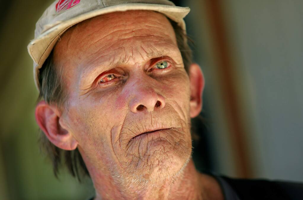 Robert Percy lost his right eye after it was burned by an ember while he battled the Tubbs fire near his home in the Coddingtown Estates mobile home park. FEMA has denied financial assistance for his case. (photo by John Burgess/The Press Democrat)