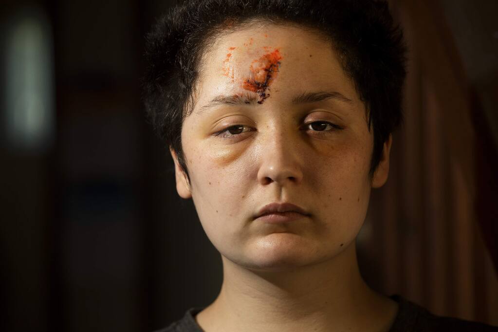 Micheala Staggs was injured early Sunday morning, May 31st, when a chalk projectile hit her in the forehead while protesting the death of George Floyd. (photo by John Burgess/The Press Democrat).
