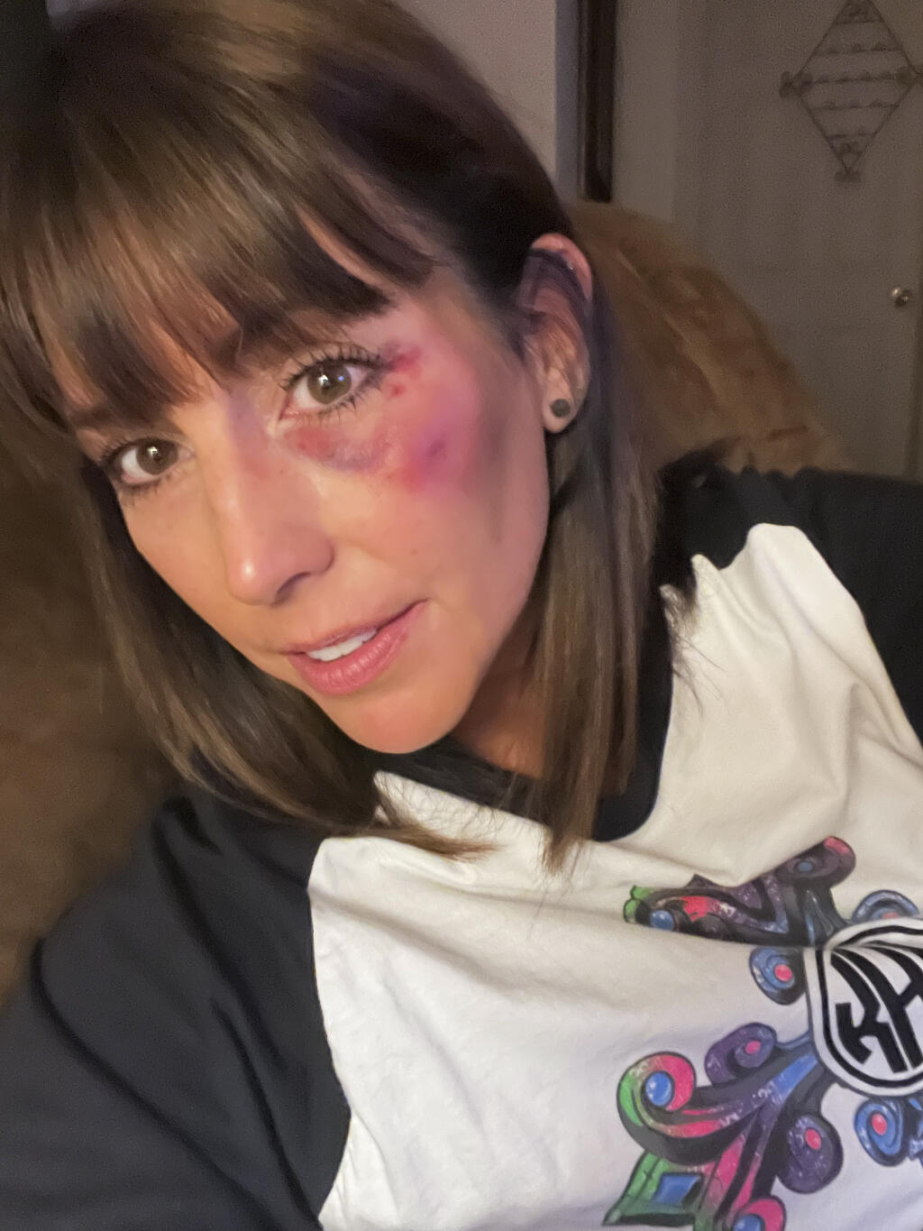 In this 2022 image released by Kristi Moore, Moore poses for a self portrait showing her bruised left eye, in Miss. On a play at second base, Moore called the runner safe. A woman watching the game thought the runner was out. She began screaming profanities, according to Moore. "I was maybe three steps off the field and she was there," Moore recalled. "And that's when she punched me." The woman was arrested and charged with simple assault. (Kristi Moore via AP)