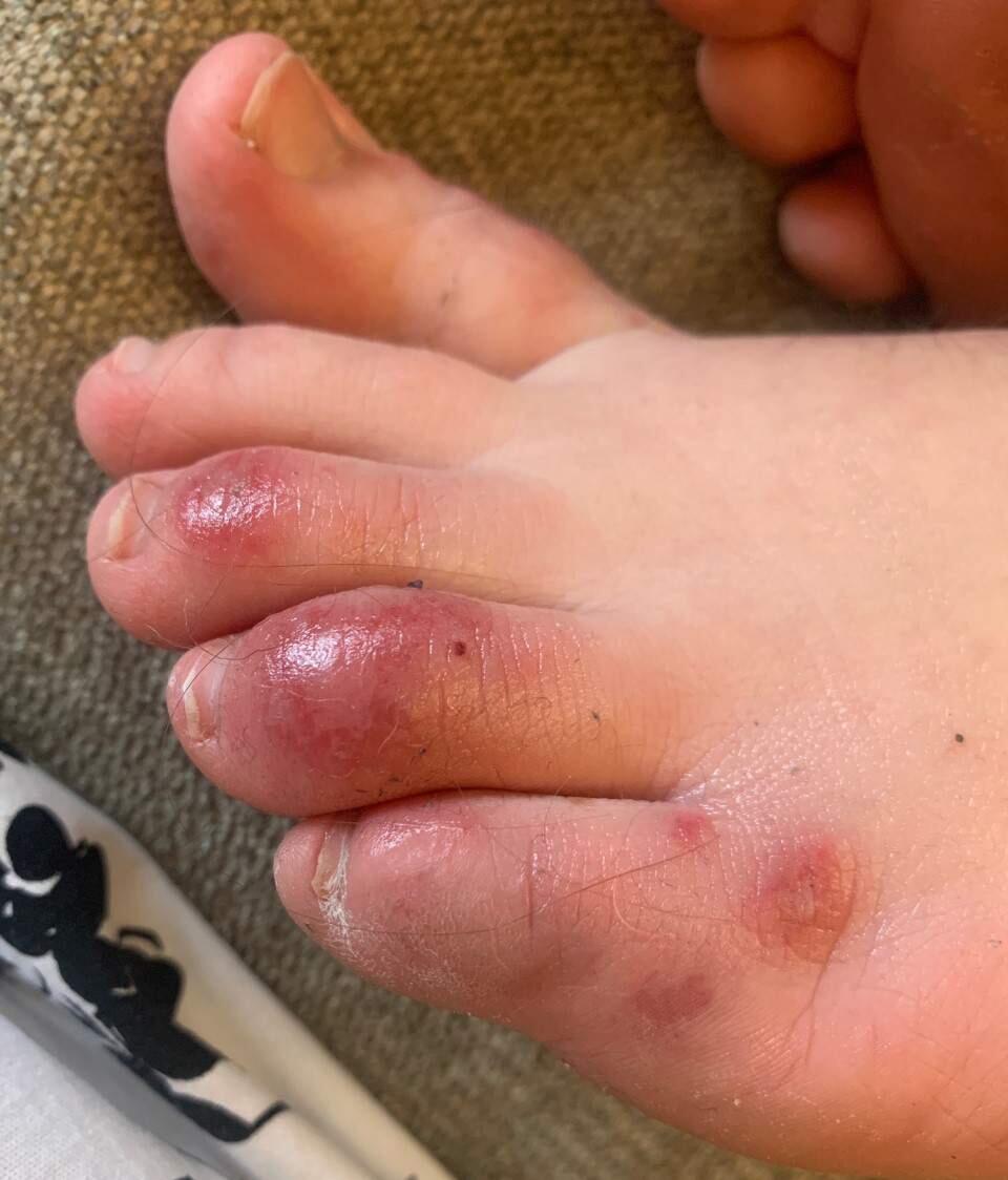This April 6, 2020 photo provided by Northwestern University shows discoloration on a teenage patient's toes three days after the onset of the condition informally called 'COVID toes.' The red, sore and sometimes itchy swellings on toes look like chilblains, something doctors normally see on the feet and hands of people who've spent a long time outdoors in the cold. (Courtesy of Dr. Amy Paller/Northwestern University via AP)