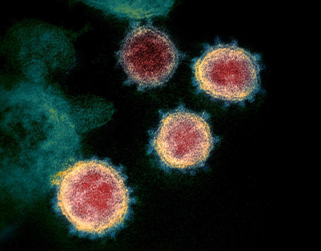 A photo provided by Elizabeth R. Fischer/National Institute of Allergy and Infection Diseases' Rocky Mountain Laboratories, a coronavirus sample collected from one of the first cases in the United States. Because this coronavirus is so new, experts' understaing of how it spreads is limited. (Elizabeth R. Fischer/National Institute of Allergy and Infection Diseases' Rocky Mountain Laboratories via The New York Times) -- FOR EDITORIAL USE ONLY. --