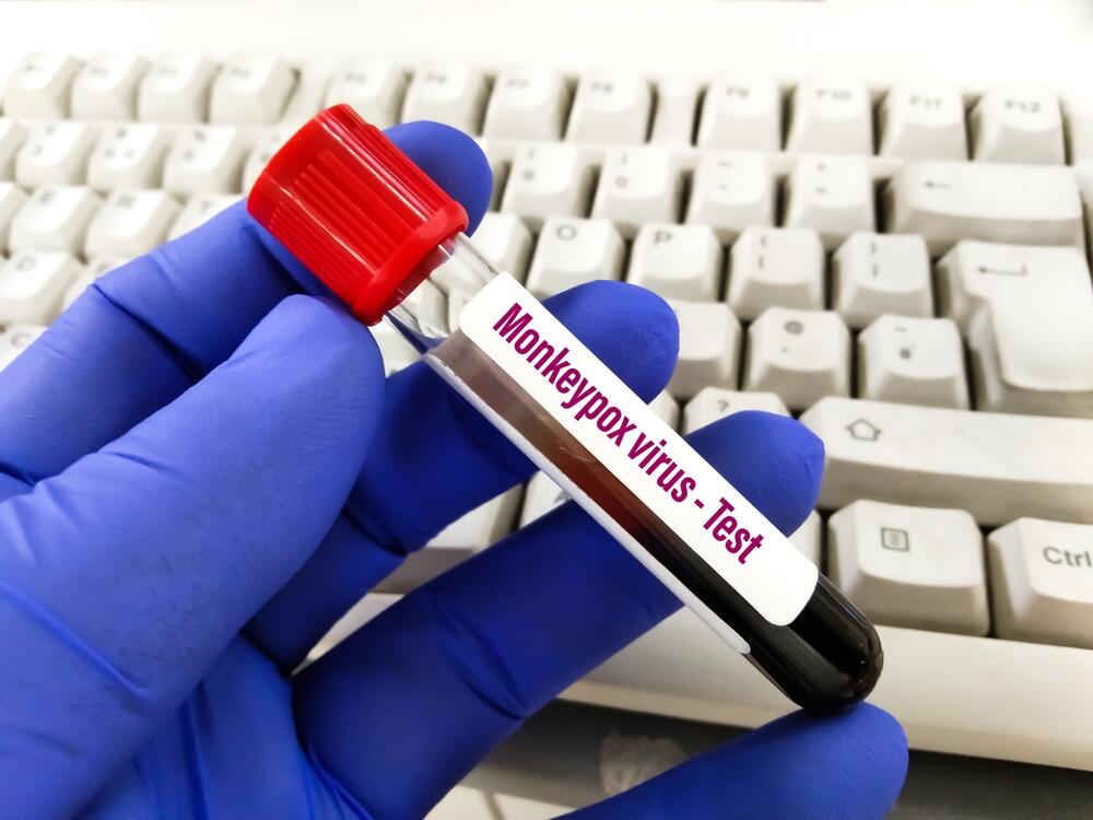 Blood sample for Monkeypox virus test. It is also known as the Moneypox virus, is a double-stranded DNA, zoonotic virus and a species of the genus Orthopoxvirus. Which is concerned for people.
