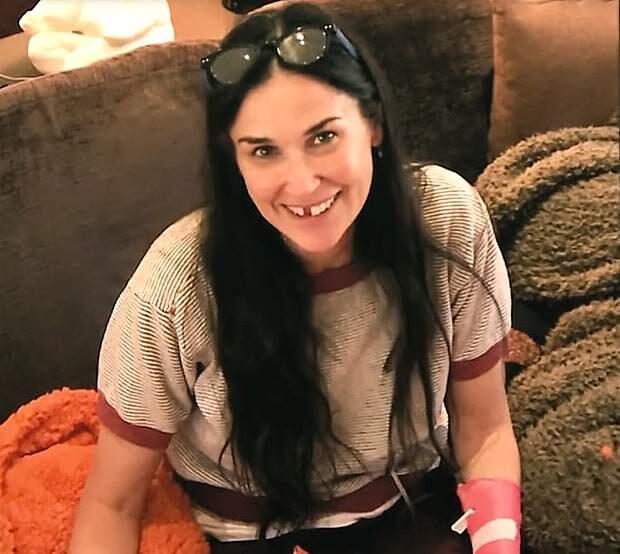 Actress Demi Moore shared a selfie of her toothless smile on The Tonight Show June 12, 2017. Moore explained that stress was the cause.