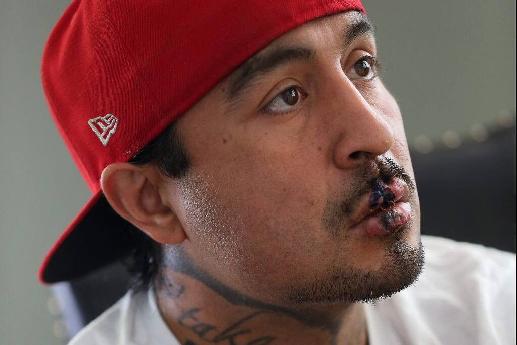 Marqus Martinez suffered a split upper lip, shattered front teeth, and broken facial bones when he was struck in the face by what he believes to be a sting ball grenade, launched by law enforcement, while protesting against police brutality near Mendocino and College avenues in 2020. (Christopher Chung / The Press Democrat)