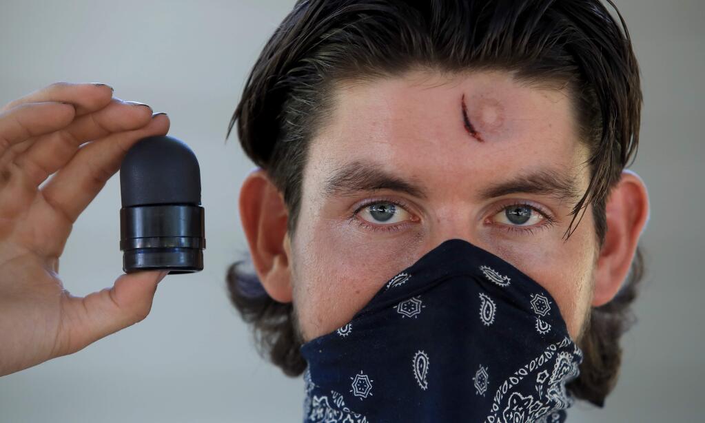 Ryland Stamey, Thursday, June 4, 2020, was injured by a rubber bullet during the first night of the George Floyd protests in Santa Rosa last Saturday, (Kent Porter / The Press Democrat) 2020