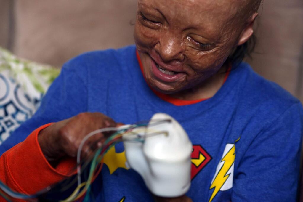 Julian Reynoso, 10, is fitted for a prothetic hand on June 1, 2019, in Los Angeles, California. Julian survived a car crash in 2018 but was badly burned and lost 9 of his fingers. (Photo By Dania Maxwell / Los Angeles Times)