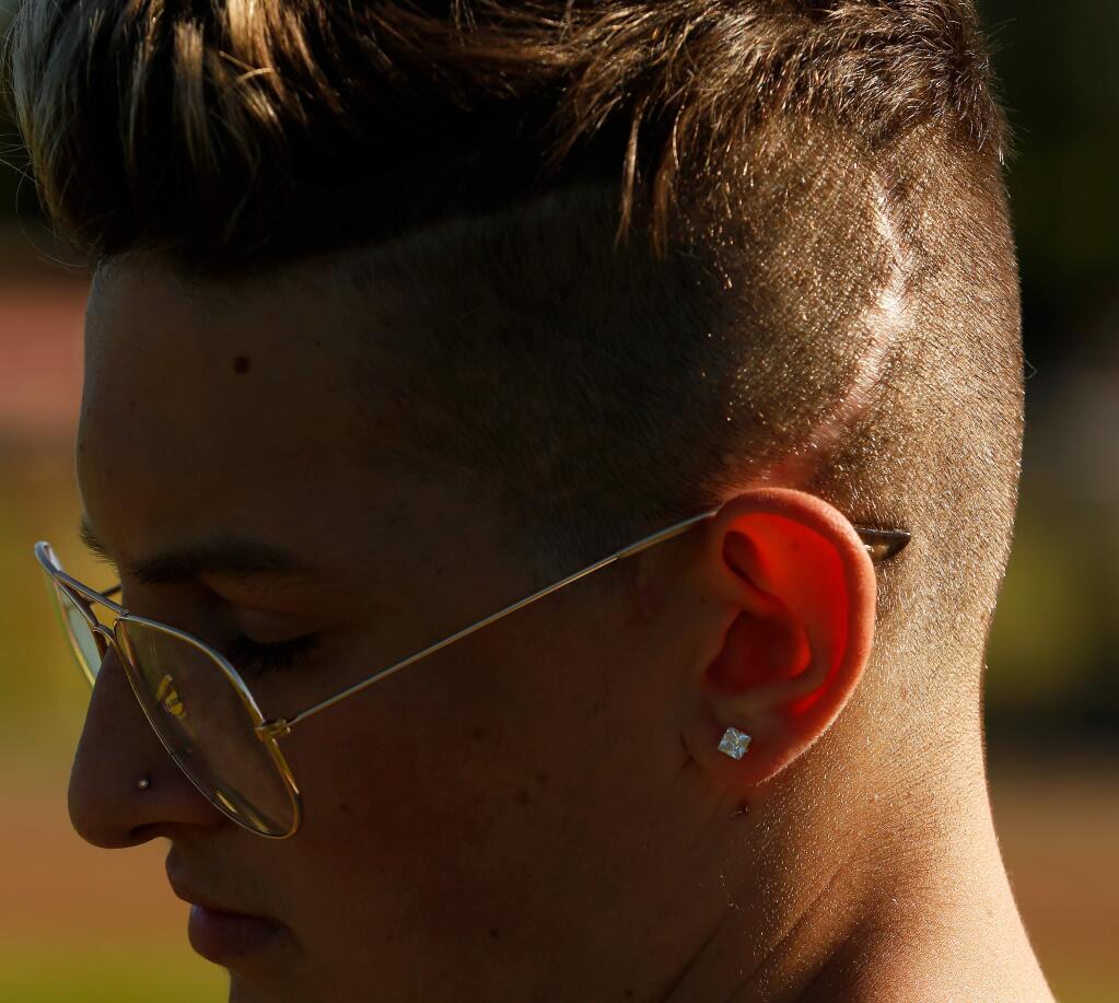 The scar on Kellen Smith's head is evidence of the injuries he suffered in a car accident last year, which prevented him from starting as the varsity quarterback this year, at Upper Lake High School, in Upper Lake, California, on Tuesday, October 1, 2019. (Alvin Jornada / The Press Democrat)