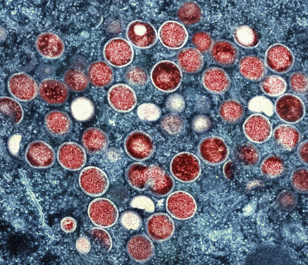Sacramento’s monkeypox outbreak has been resolved, a health spokesperson said Monday, after the county reported no new cases among residents for more than a month.This image provided by the National Institute of Allergy and Infectious Diseases (NIAID) shows a colorized transmission electron micrograph of monkeypox particles (red) found within an infected cell (blue), cultured in the laboratory that was captured and color-enhanced at the NIAID Integrated Research Facility (IRF) in Fort Detrick, Md. (NIAID via AP, File)
